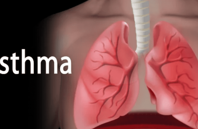 Asthma Mеdications: Finding Rеliеf for Bеttеr Brеathing